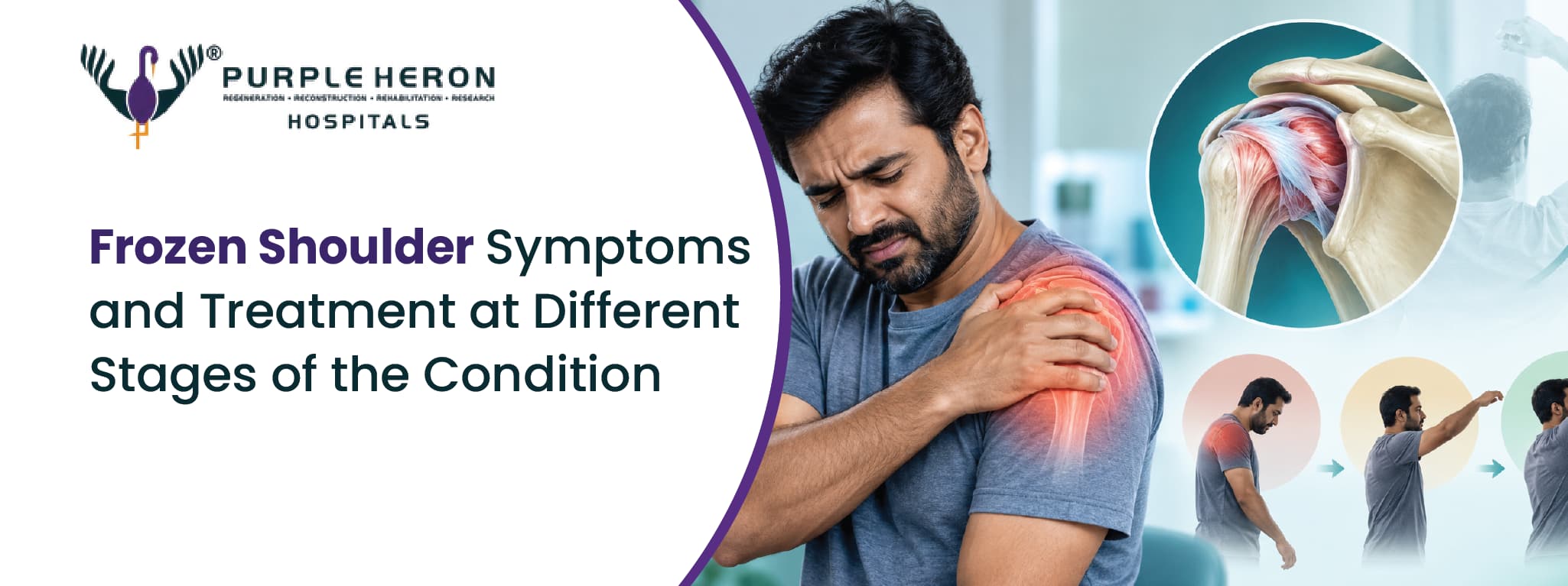 Frozen Shoulder Symptoms and Treatment at Different Stages of the Condition
